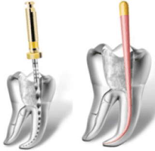 endodonzia 1