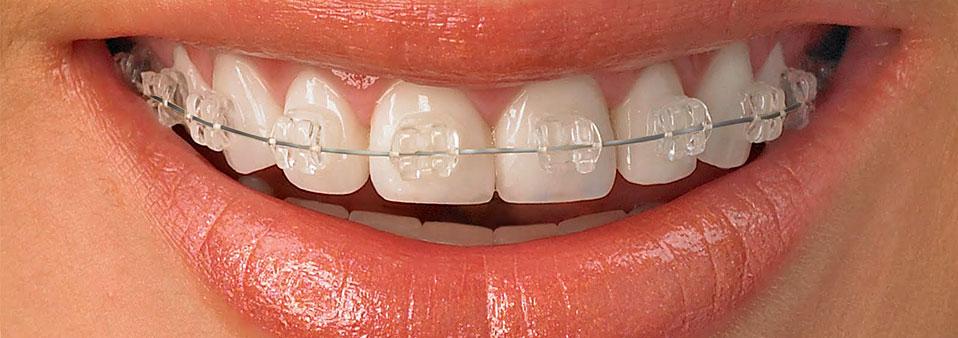 ortodonzia fissa brackets in ceramica