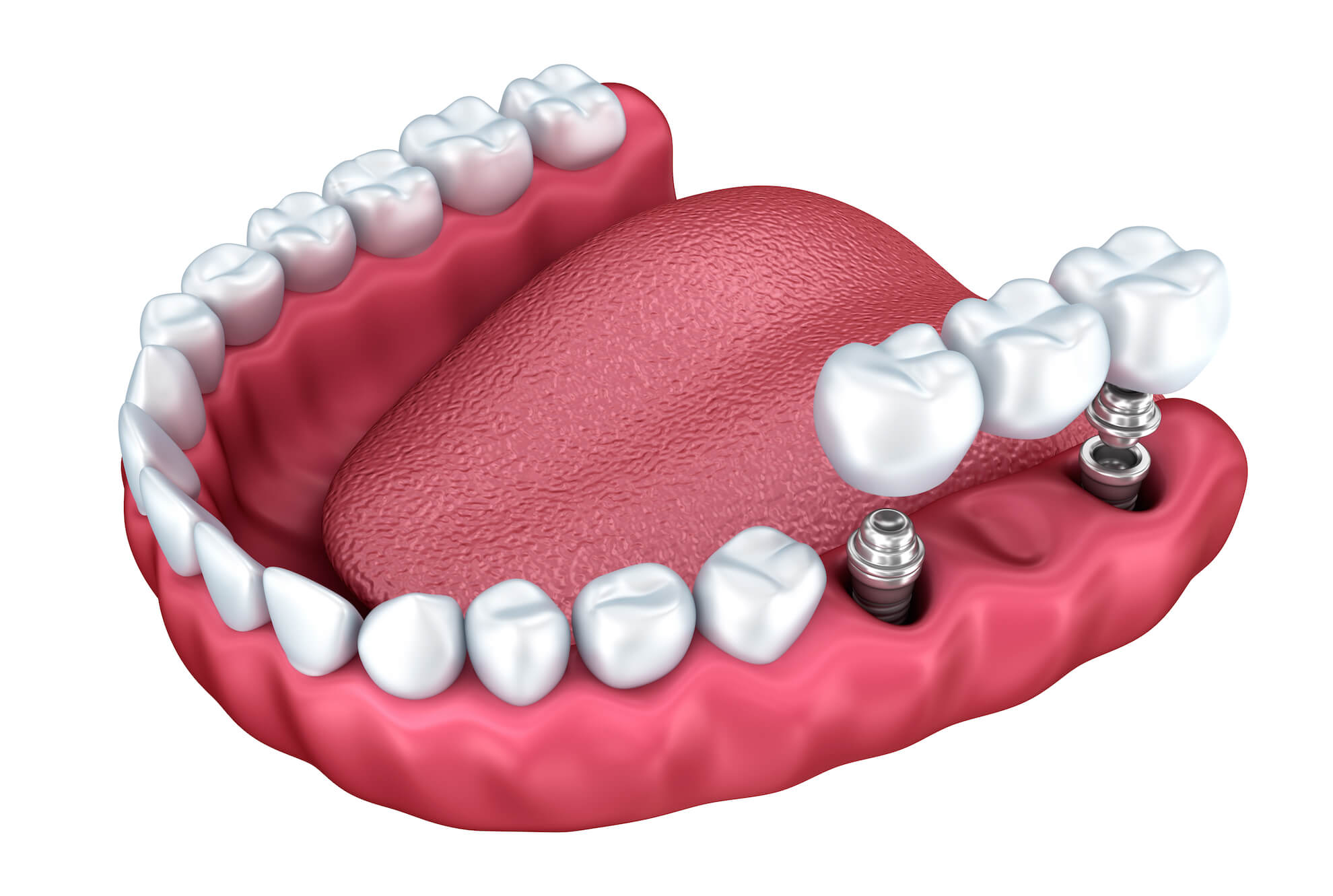 protesi-fissa-su-impianti-dentali
